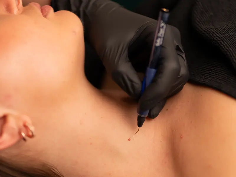 Cryon specialist verwijdert een huidoneffenheid bij een klant in de schoonheidssalon in Breda.